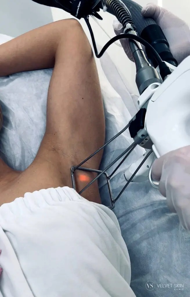 Urządzenie Lightsheer używane do depilacji laserowej w klinice